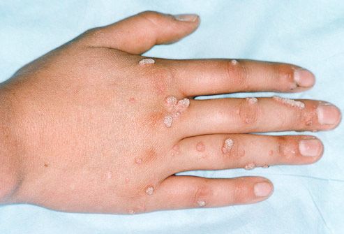 Mụn cóc thường có màu trùng với da